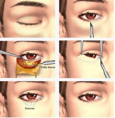 Illustration for upper and lower blepharoplasty