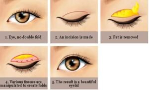 Illustration for upper blepharoplasty