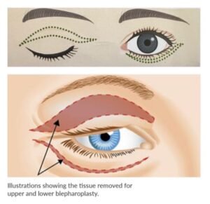 Blepharoplasty