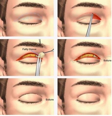Illustration for upper and lower blepharoplasty