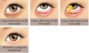 Illustration for transconjuntival lower blepharoplasty