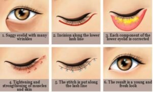 lower blepharoplasty