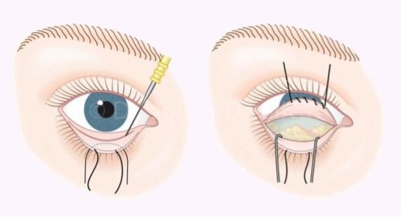 Illustration for transconjuntival lower blepharoplasty